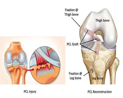 Arthroscopy