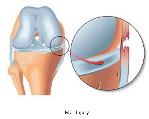 Other Ligament Injury