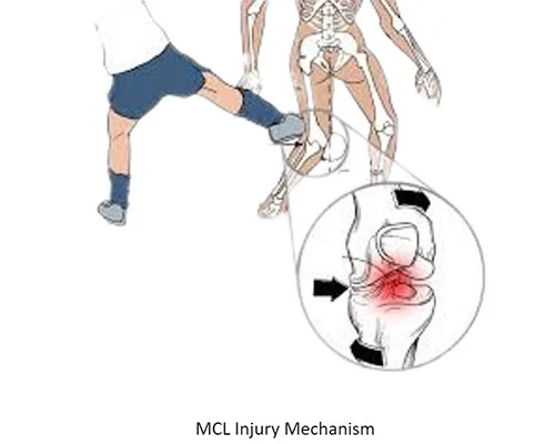 Other Ligament Injury – illustration 2