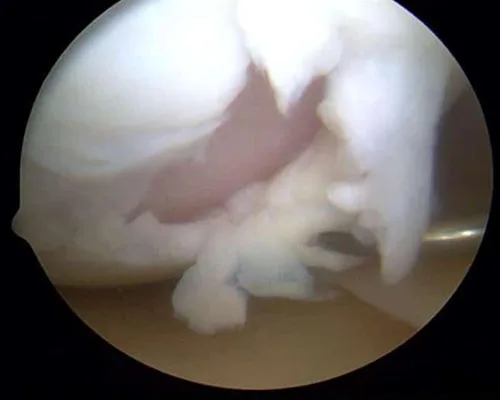 Knee Cartilage Injury