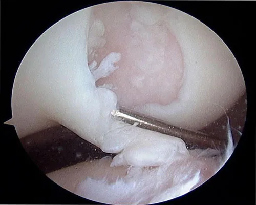 Knee Cartilage Injury – illustration 2