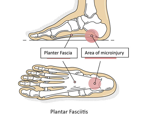 Plantar Fasciitis - Vasta Performance Training and Physical Therapy