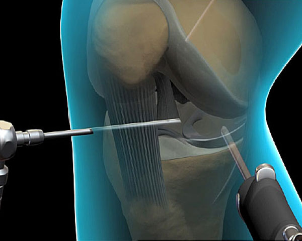 Arthroscopy